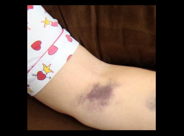 Hematoma Após Coleta 